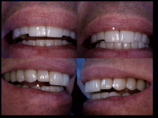 porcelain veneer Los Angeles