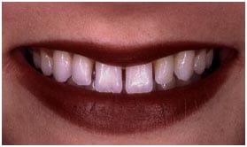 Porcelain veneers Los Angeles