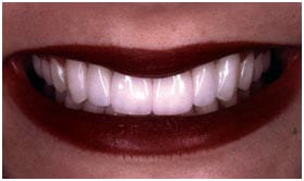 Porcelain veneers Los Angeles