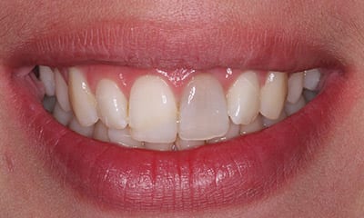 Before dark tooth, and chipped tooth, porcelain veneer