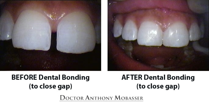 Dental Bonding to close gap (2)