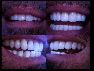 Facettes dentaires avant et après