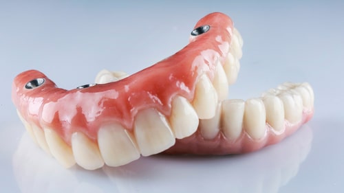 Gli impianti dentali possono far venire la carie dentista implantologo di Los Angeles