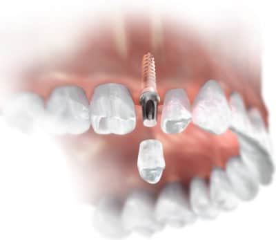 Implants dentaires à Beverly Hills Dentiste cosmétique Dr. Anthony Mobasser