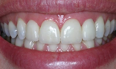 瓷贴面与牙科粘接术后的对比