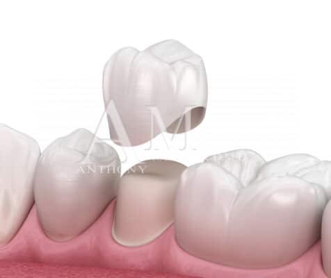 Corona dentale in porcellana vs impianto dentale, con un dente fratturato