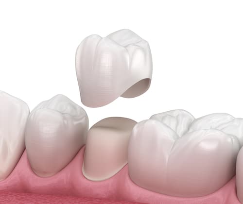 Corona dentale in porcellana vs impianto dentale, con un dente fratturato