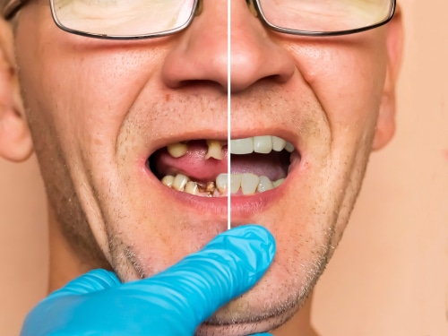 Ce que vous pouvez faire pour changer lorsque les dents sont tordues
