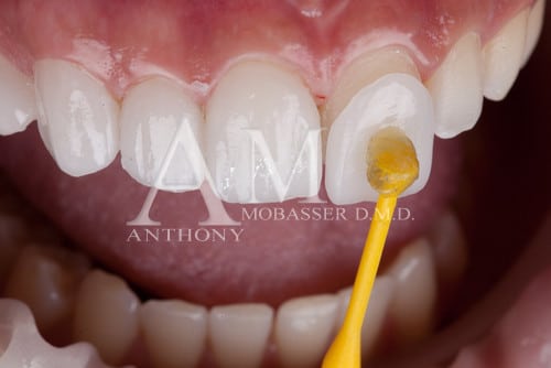 Préparation des dents pour les facettes en porcelaine Dr. Anthony Mobasser