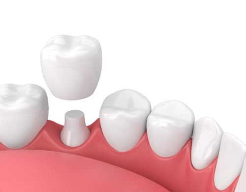 Two Main Differences Between Crowns and Porcelain Veneers