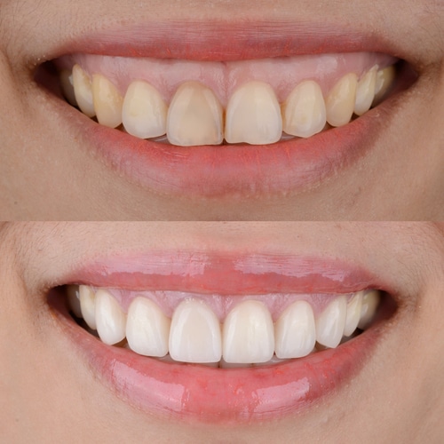 What are the uses of Porcelain veneers Los Angeles