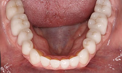 full mouth reconstruction