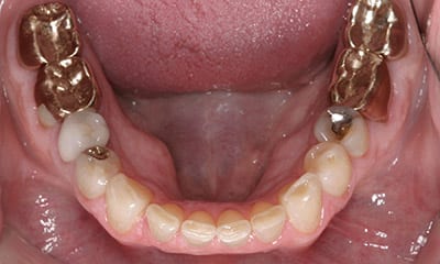 Before full mouth reconstruction