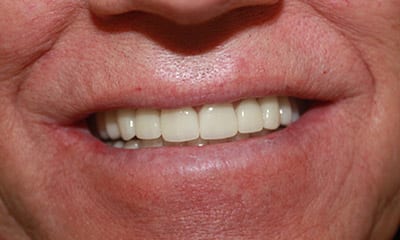 reconstruction complète de la bouche