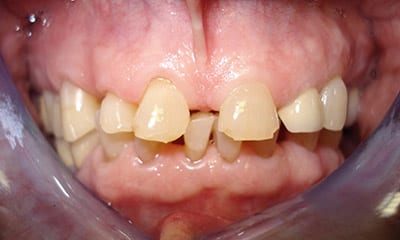 Avant la reconstruction complète de la bouche