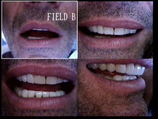 Full Mouth Los Angeles Dental Reconstruction