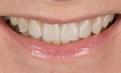 使用 EMAX 烤瓷矫正牙龈型微笑后的效果