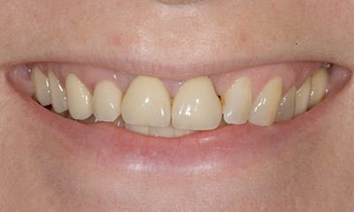 Avant : Dents tordues et décolorées avec sourire gingival