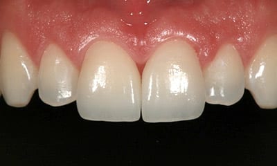 Before & After Pictures Porcelain Crowns