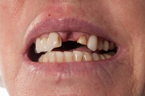 修复牙齿的最佳方法是什么？