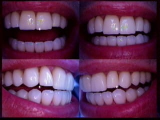 After Porcelain Veneers