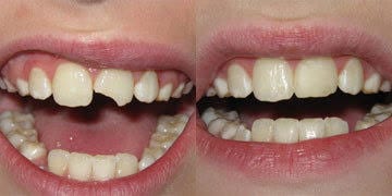 異なる歯科医で何度も試された、チップ・ボンディングの前歯のための対処法