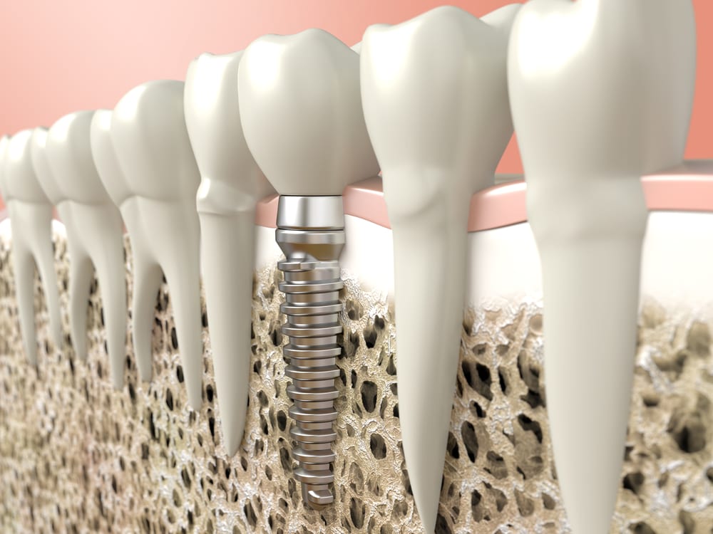 who-is-the-best-dental-implant-dentist-in-los-angeles