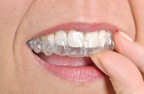 qu'est-ce qu'un alignement invisible ? quand le dentiste l'utilise-t-il ?