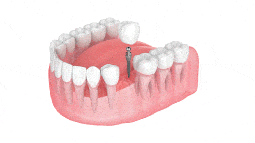 Qui est le meilleur dentiste pour les implants dentaires à Beverly Hills ?