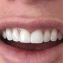 Sbiancamento dei denti per denti cementati