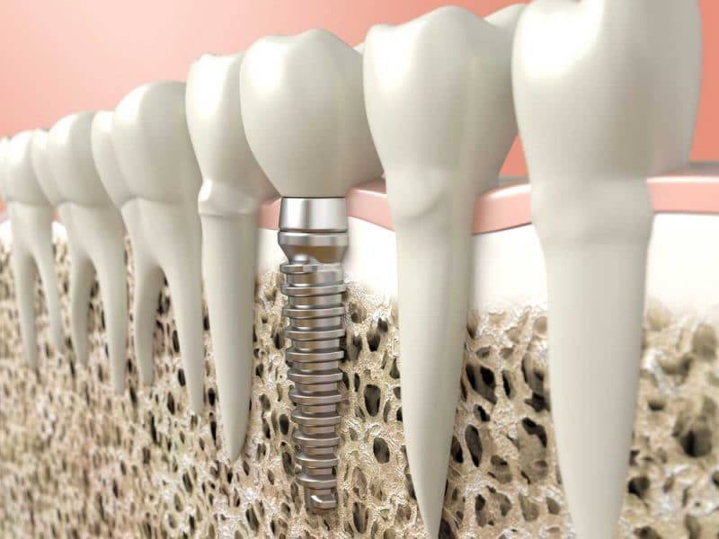 Dental Implants in Los Angeles | Dr. Anthony Mobasser