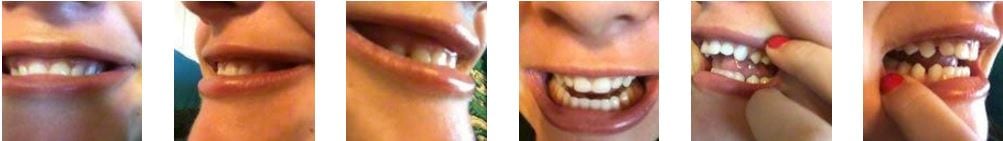 les dents écartées