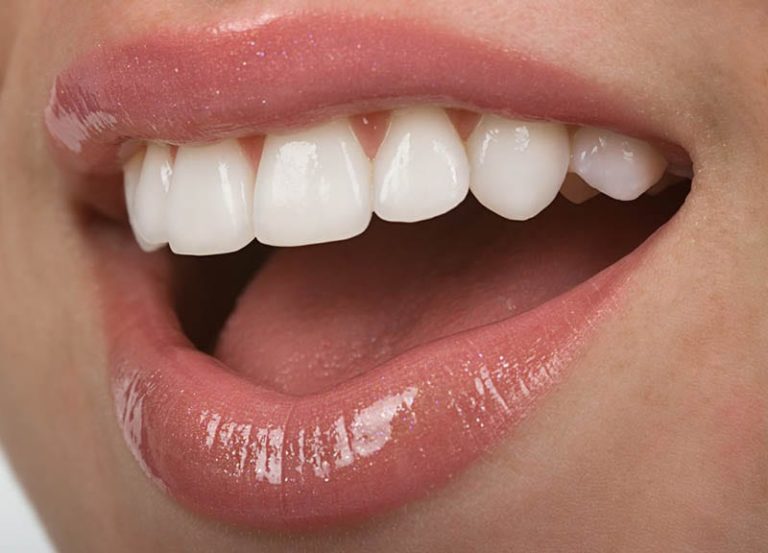 How Much Do Veneers Cost? Los Angeles Porcelain Veneer Dentist