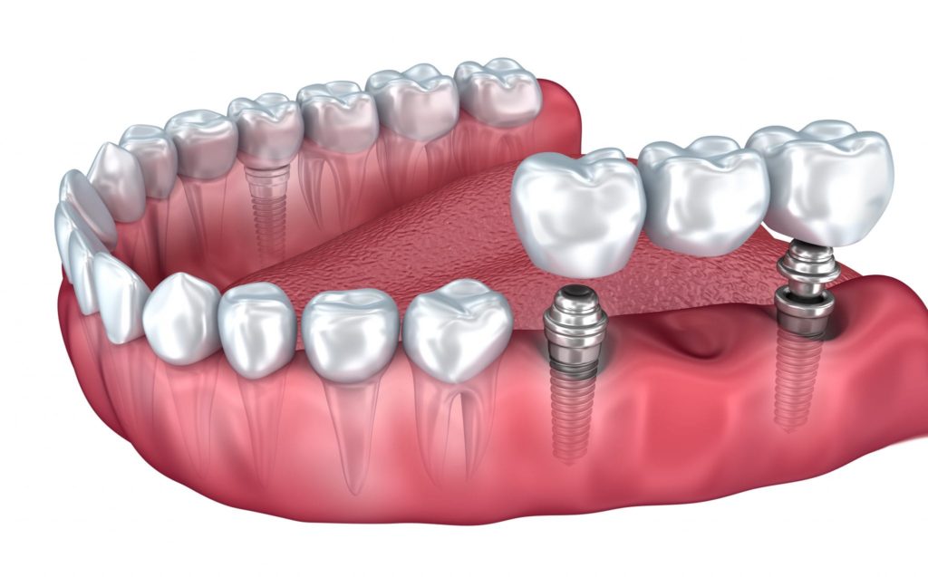 How to get fine Dental Implants in Los Angeles