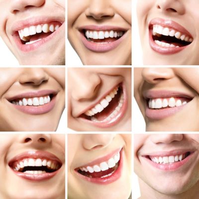 El mejor dentista cosmético en Beverly Hills que ofrece un cambio de sonrisa