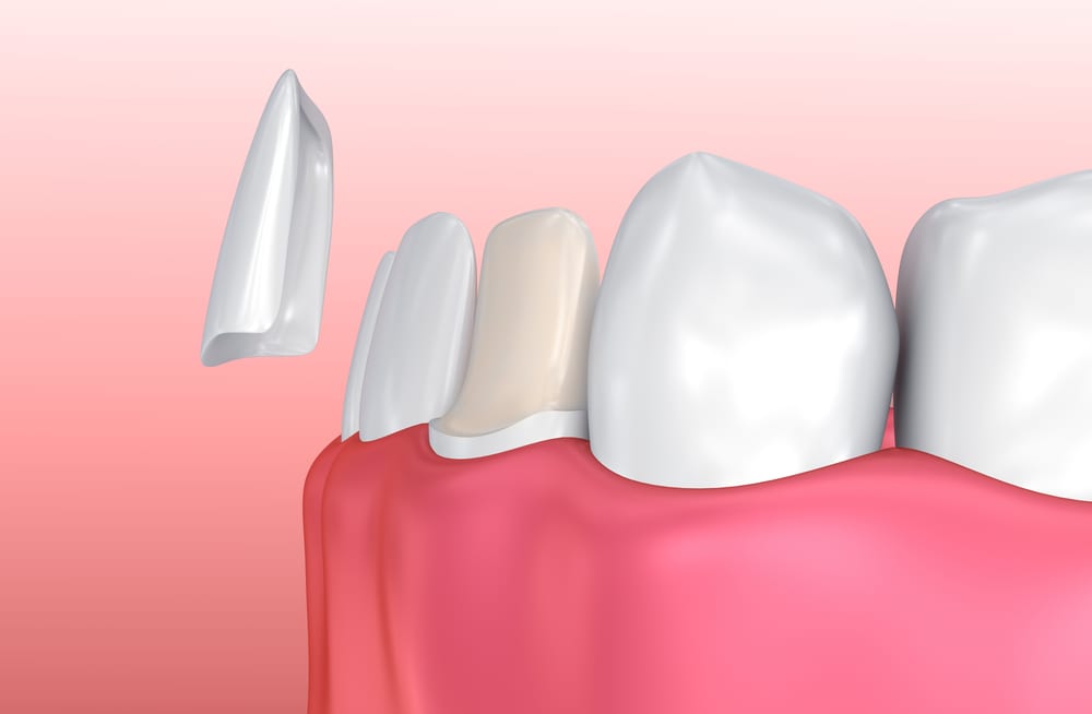 Le dentiste esthétique de Beverly Hills peut répondre à la question de savoir si les facettes en porcelaine vous conviennent.