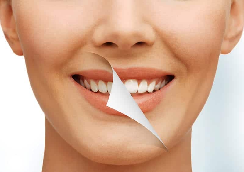 Teeth Whitening services in Los Angeles