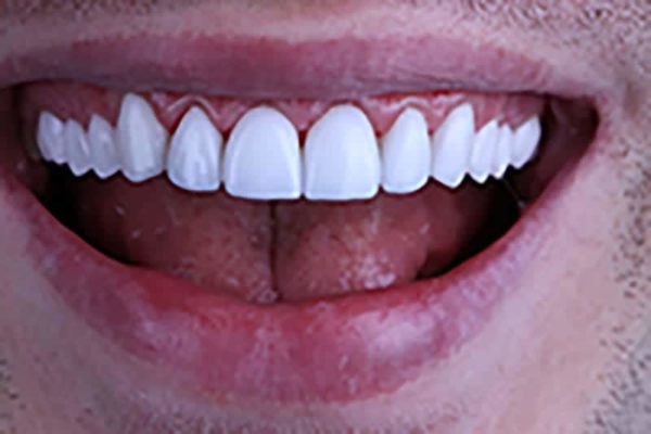 Enhance Your Smile with Porcelain Veneers in Beverly Hills