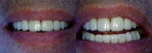 Facettes dentaires avant et après