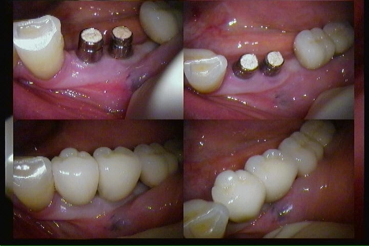 les meilleurs avant-après-implants dentaires