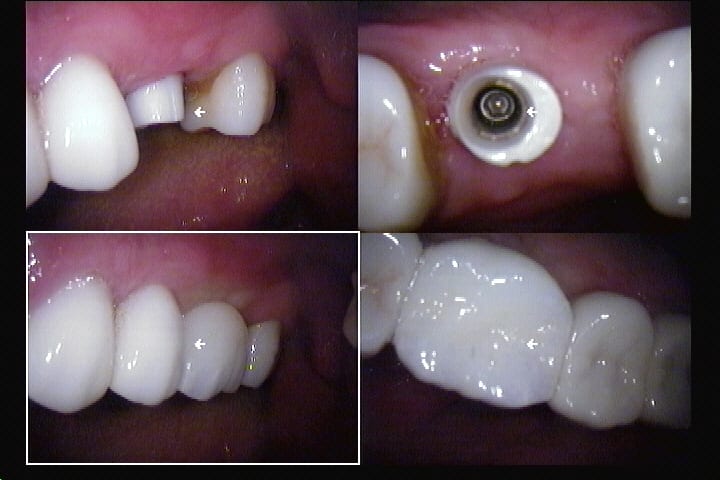 LA implant dentist