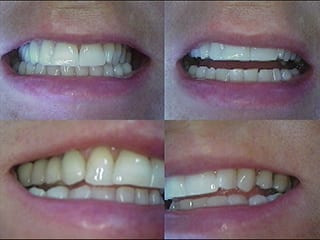 Dopo la ricostruzione dentale
