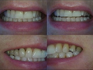 Dopo la ricostruzione dentale