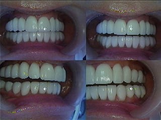 After Dental Reconstruction