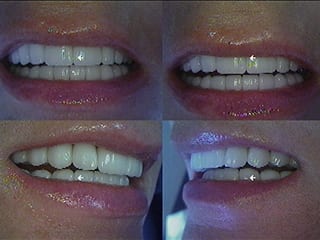 After Dental Reconstruction