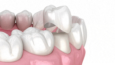 Il processo di ottenimento delle corone dentali | California | Dr. Mobasser