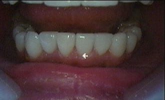 facettes dentaires-avant-après