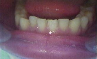 carillas-dentales-antes-despues