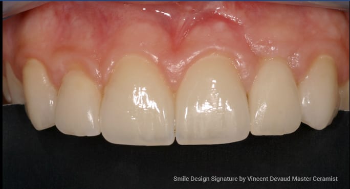 After Dental-Implants