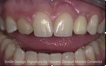 before Dental Implants